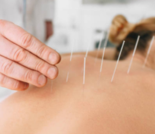 acupuncture near you